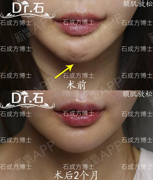 case no.643 颏肌放松,去除"核桃皮",光滑的小下巴.