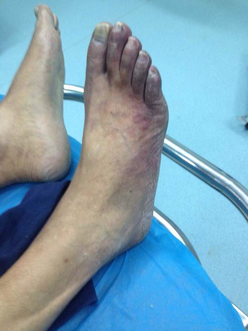 下肢动脉硬化闭塞症伴糖尿病足 足部缺血介入治疗病历