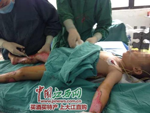 德兴被汽油烧伤小男孩首次手术顺利 后期仍需多次手术