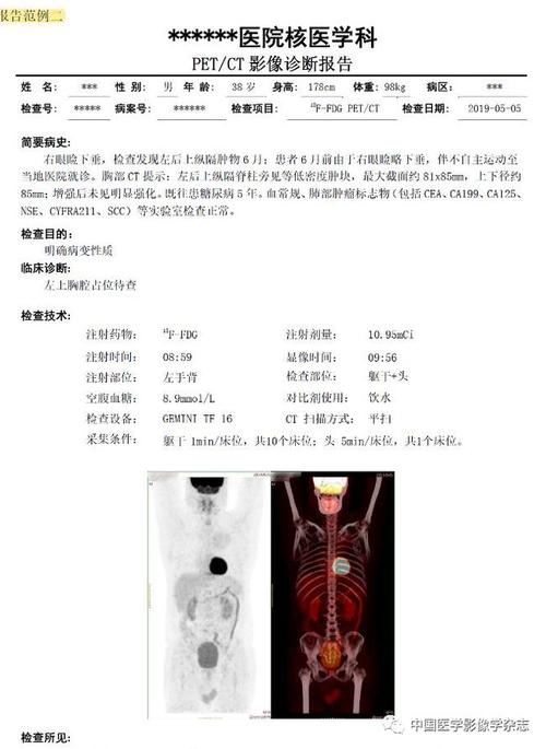 影像干货 | 核医学(18)f-fdg pet/ct报告书写规范