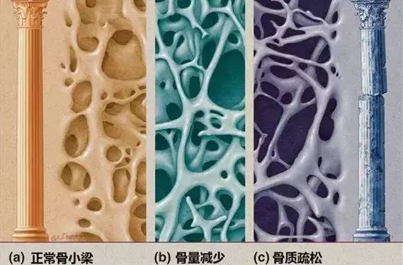 随着骨质流失,骨头外层皮质变薄,内层松质骨的骨小梁变细,断裂,孔隙