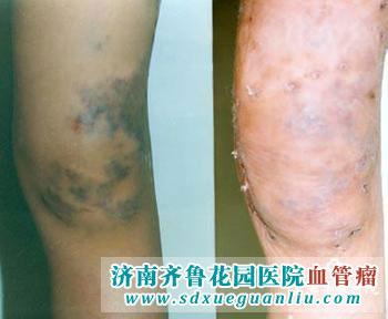 治疗血管瘤的医院讲解成人血管瘤的严重危害有哪些