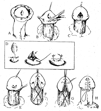尿道口前徙阴茎成型术一期修复小儿冠状沟型尿道下裂38例