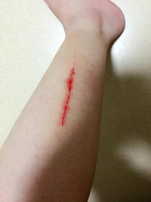 被猫抓成这样用打针吗?虽然以前也被抓出血过,但.