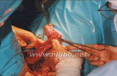 [变性手术女变男过程图]女变男变性手术全程高清图