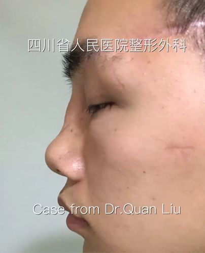 歪鼻畸形矫正 案例分享