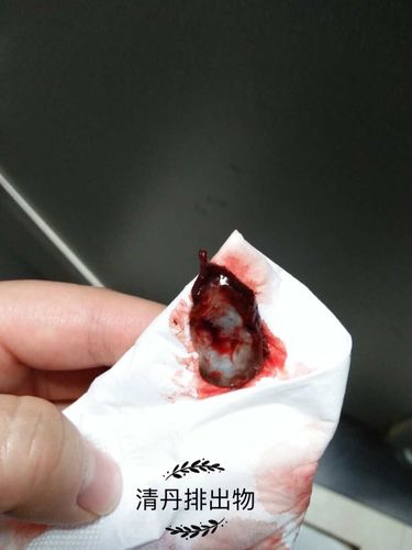 『卵巢囊肿案例』