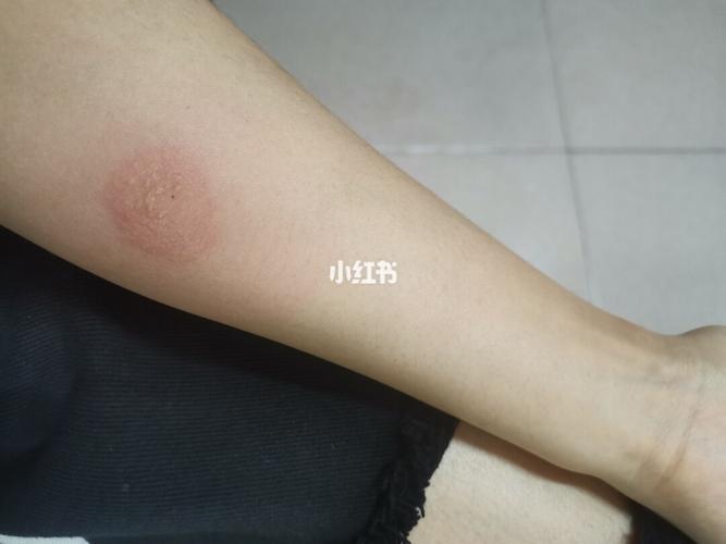做完ppd的第60小时,做皮试的地方出现双圈,红肿,水泡.