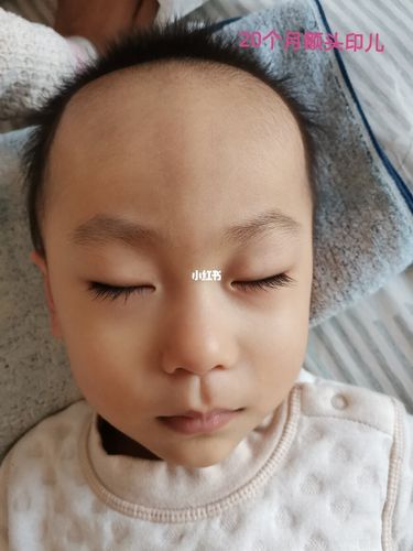 宝宝额头被产道挤压的红印要多久能下去呢?_月子_母婴