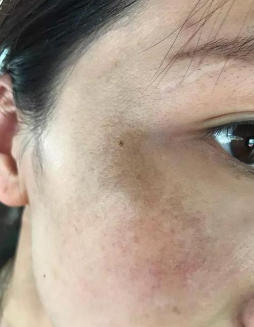 旧药新用:逍遥丸,归脾丸,六味地黄丸,原来对黄褐斑还有效