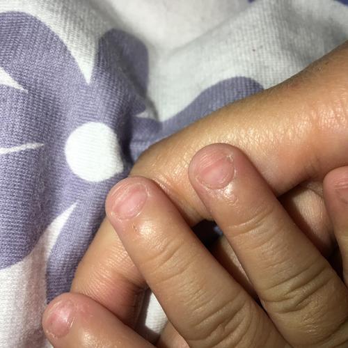 有经验的宝妈帮我看一下宝宝指甲这样是不是缺钙