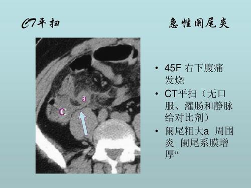 急性阑尾炎ct诊断鉴别诊断