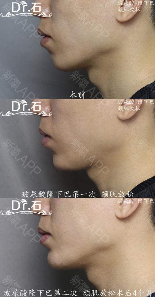 633 颏肌放松玻尿酸分次注射隆下巴,放松"核桃皮",塑造一个圆润翘起的
