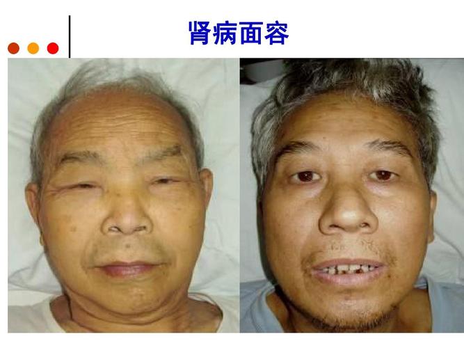 慢性肾功能衰竭及护理ppt