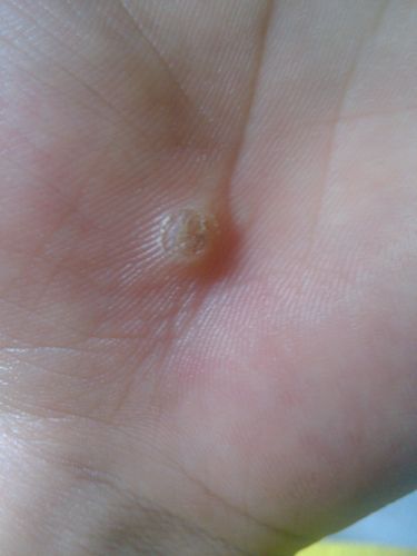 手上5个,脚上也有.开始少,现在有七八个.怎么办啊? 手上5个,脚上也有.