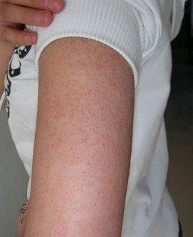 什么皮肤病要怎么护理