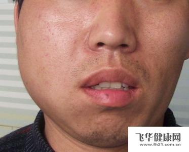 颊间隙感染怎么办