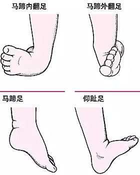 小孩刚出生,先天性马蹄足内翻,需要多久才能治好?得花