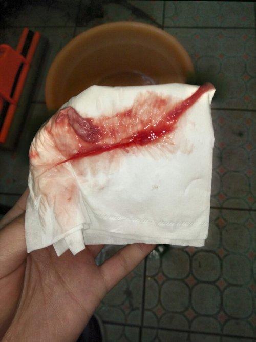 宫腔粘连手术五个月了,上个星期刚取了环,说恢复的蛮好,可是最近,阴道