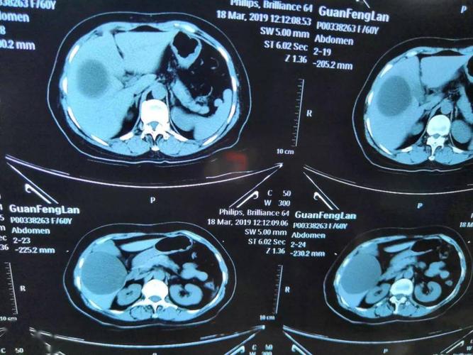 大肝囊肿无需传统手术 ——彩超下超微创20分钟解病痛