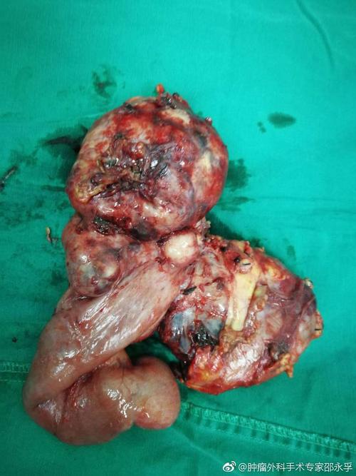 这是邵永孚去海南为病人切除的部份恶性肿瘤,如有不适