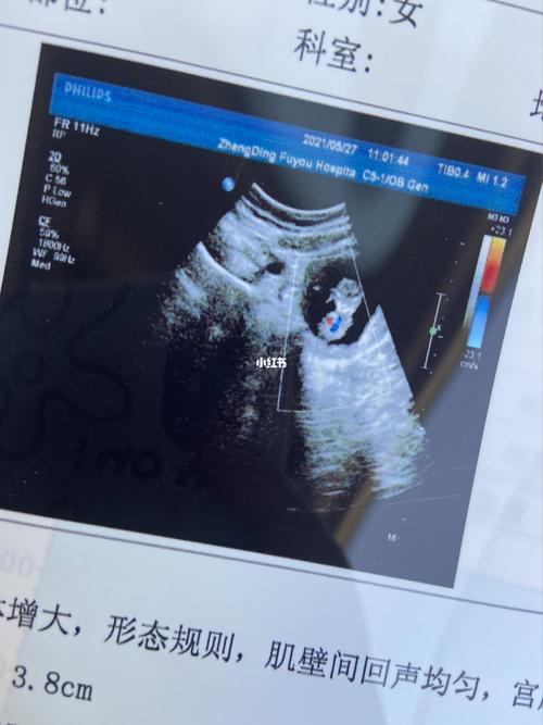 头次发我宝的彩超图片_怀孕_日记_快乐都_辞职_焦虑_怀孕日记_母婴_孕