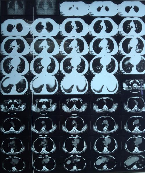 白银市第一人民医院肺癌mdt病历汇报(呼吸二科)