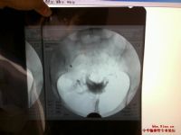 根据b超动态监测可分为小卵泡型,卵泡滞留型及持续增大型三种类型.