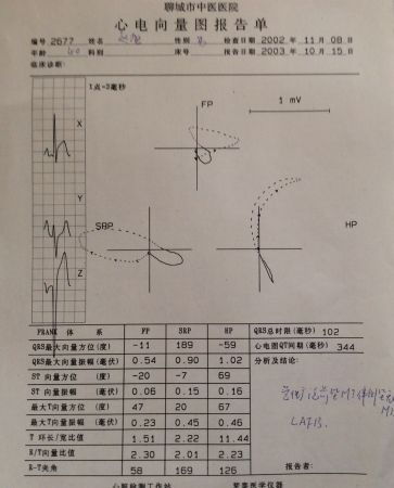 看心电图熟悉向量图--图71,72--前壁心肌梗死