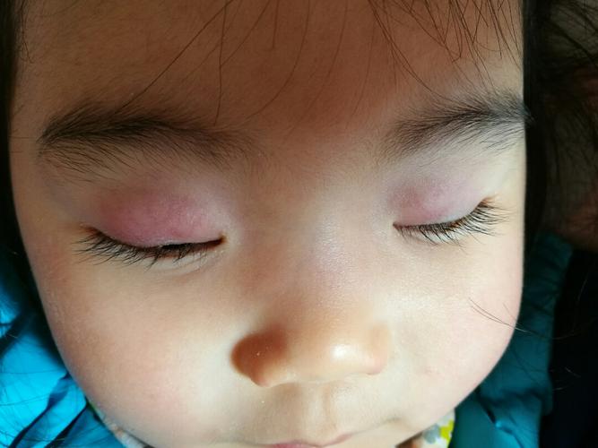 宝贝一岁五个月眼睛长了麦粒肿去医院给开了玻璃酸钠滴眼液和