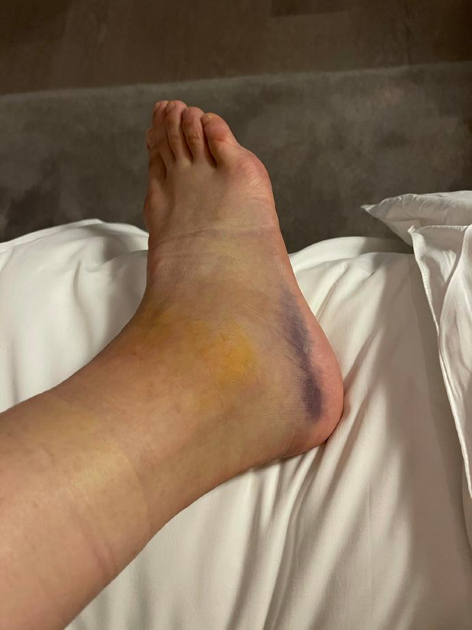 袁咏琳脚踝扭伤导致距腓前韧带撕裂 晒受伤照称第一次