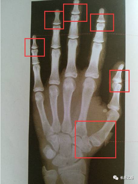 教你简单识别孩子的骨龄片