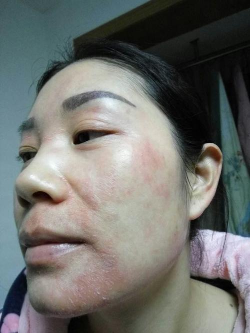 雯雯激素脸蜕变记