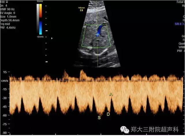 中晚孕期正常胎儿静脉导管血流频谱分析