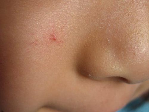 血管瘤的早期症状