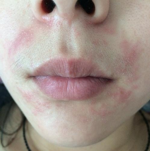 各位网友,这是什么?口周皮炎还是脂溢性皮