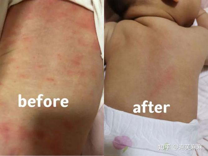 如何护理特异性皮炎宝宝?