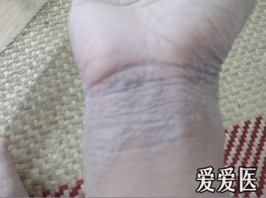 看图诊病————水源性角化病