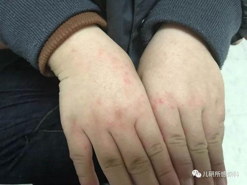 手足口病—图片集