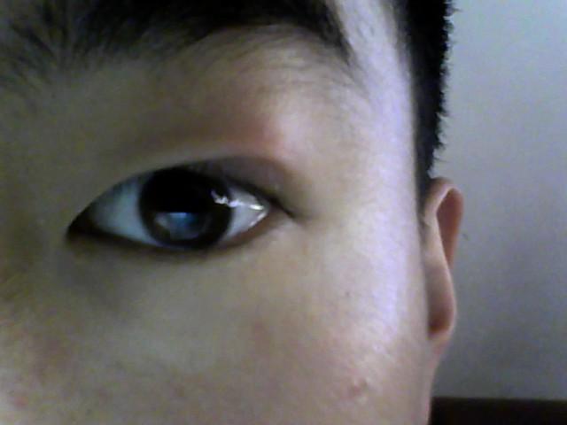 我的左眼睑靠外眼角长了一个硬块,与外眼皮无粘连,直径1.