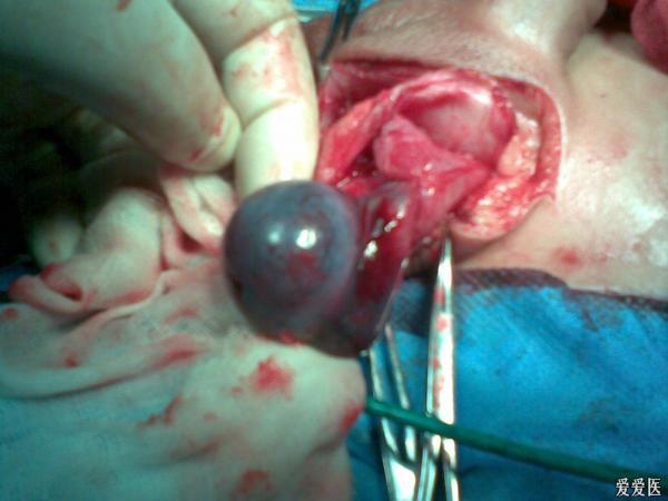 楼主langzizxx2011-03-31 21:39:03       14岁得小孩,阴囊疼了一天