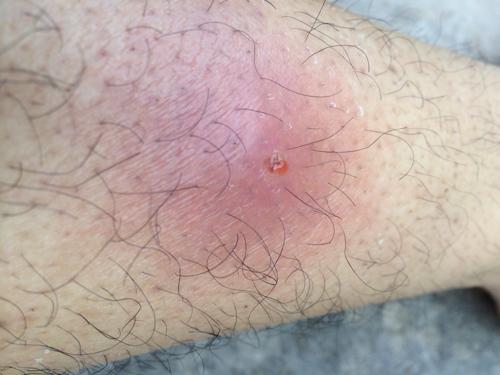 最近两个月身上和大腿总是反复起这中毒疮,硬硬的一块