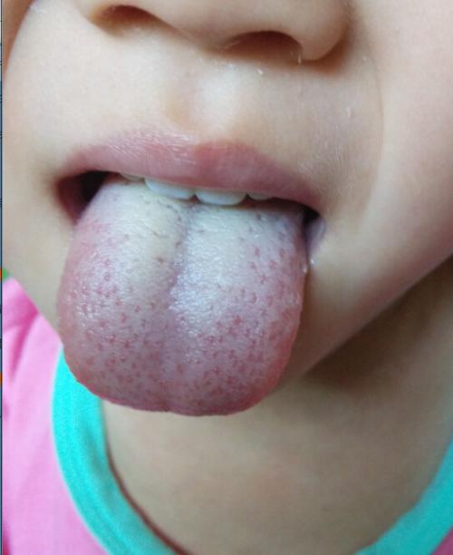 4岁孩子积食却成了"疳积",儿科主任:家中3汤水是祸首