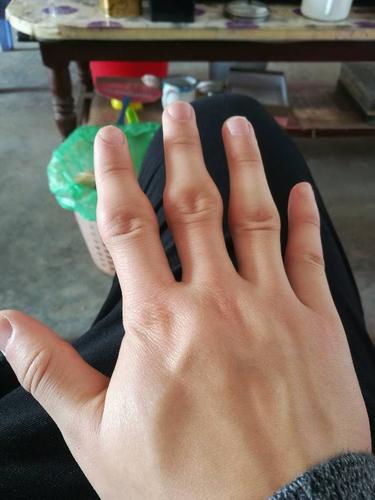 手指关节粗大,也不痛,从两年前开始突然变大了.