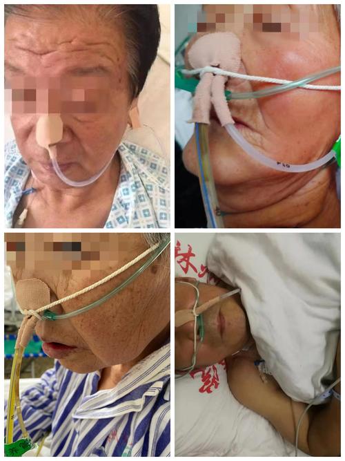 棉布或线绳固定法: 以反∞字双套结,从胃管另一端套入,固定在鼻尖下