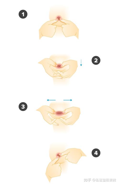 乳头内陷需要治疗吗?