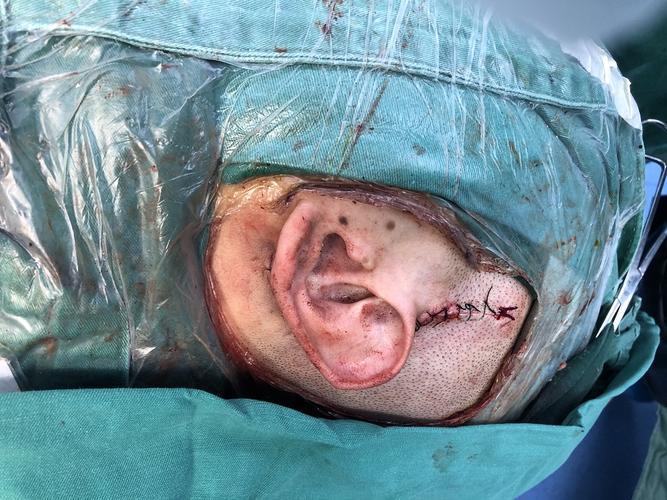 夜幕下的中民,成功实施成年人电子耳蜗植入术