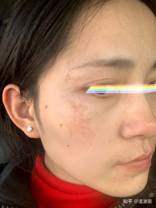 如何判别脸上斑的种类?