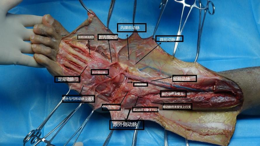 涛哥成长日记3——腓动脉穿支皮瓣修复皮肤缺损