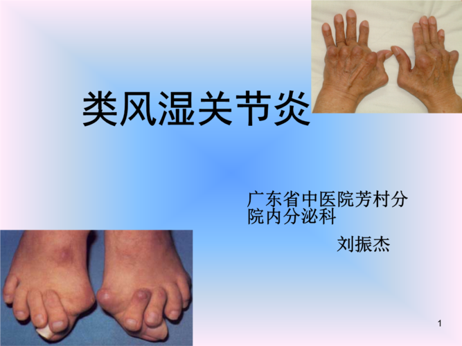 中西结合7年制教材(大量图片)类风湿性关节炎推荐.ppt